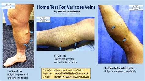 vein compression test|catheterized varicose veins.